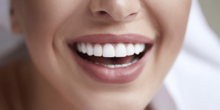 Why Composite Bonding Is Beneficial for Those Who Shy Away Because of Chipped Teeth?