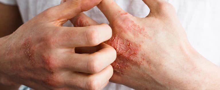 What is psoriatic arthritis and how to cure it?